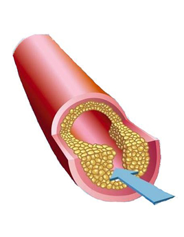 blocked artery